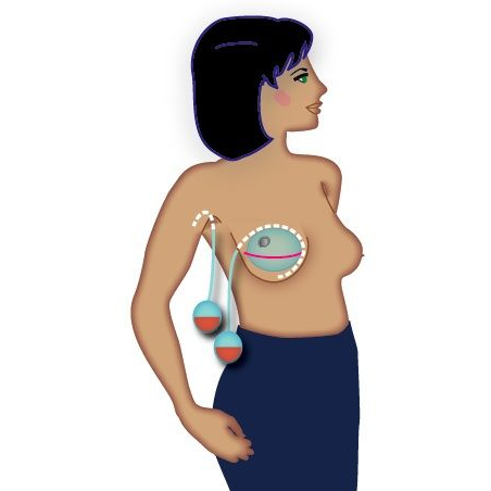 Managing Your Surgical Drains Following Breast Surgery